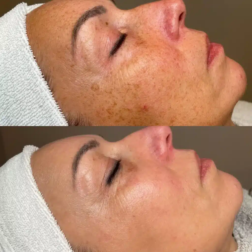 Hoe kan je pigmentvlekken behandelen?