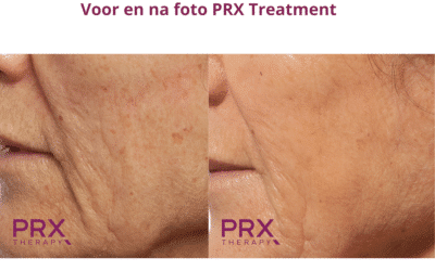 PRX-T33 TCA Peeling