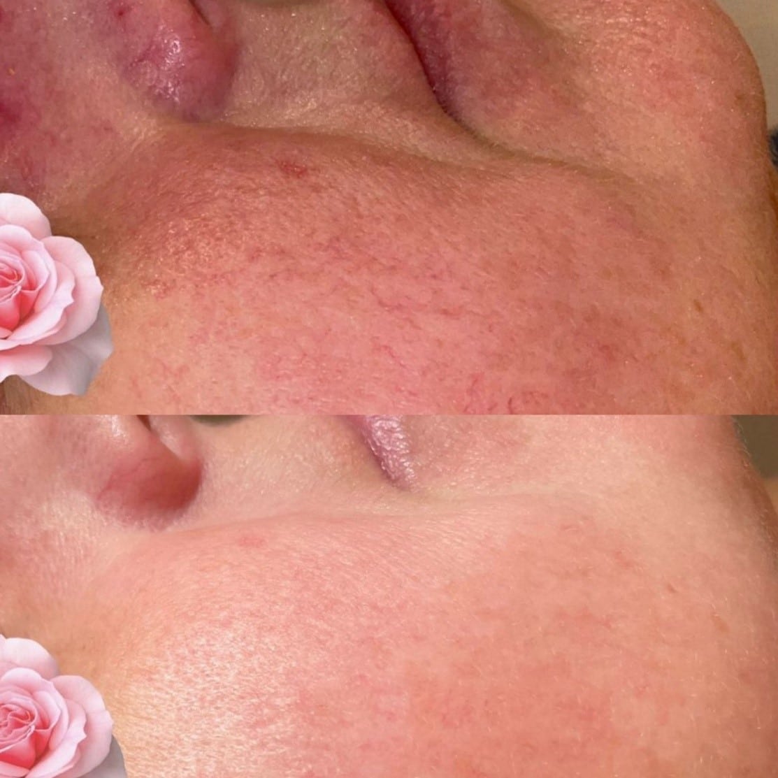 IPL therapie voor rosacea
