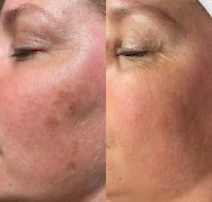 pigmentvlekken behandeling